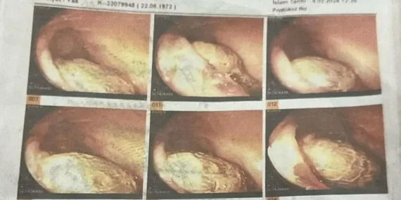 Manisa’da ameliyatta spanç unutulması iddiası: İki doktora dava